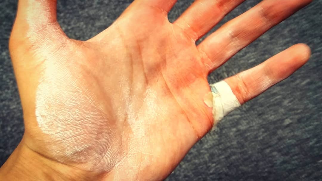 I've lost 4lbs because it's been tough to eat right; and been off the gym for 2 weeks.

I was afraid I'd lose strength, but I matched 2 weeks ago :D

I'm at a 135kg deadlift (I weigh 71.6kg), which I'm proud of, but my hand splits open every week! Just tape it up and carry on, I say :P

And getting liquid chalk in the peeled skin is painful as anything; my skin sticks to the top of my fingers :(